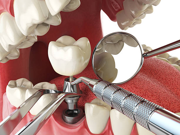 Best Emergency Root Canal Treatment in Storm Lake, IA