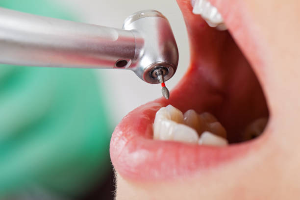 Best Emergency Dentist for Lost Fillings or Crowns in Storm Lake, IA